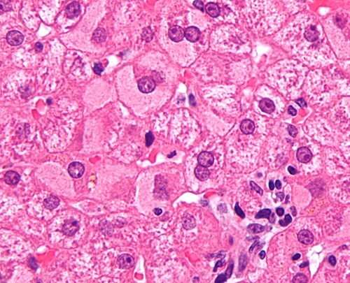 Ground_glass_hepatocytes_high_mag_cropped_2